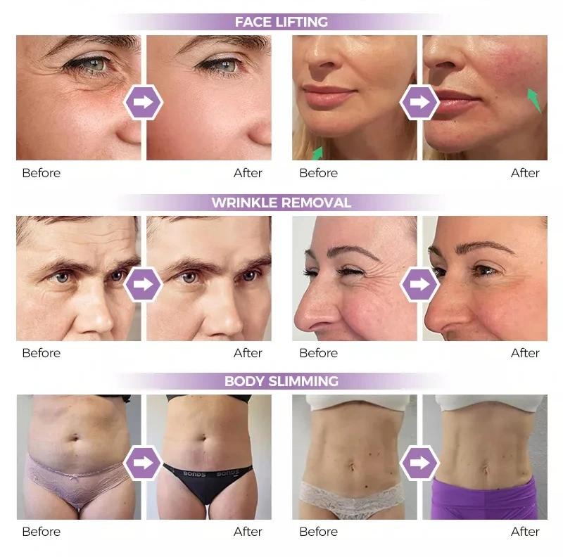 Ultralift HIFU Machine Before and After