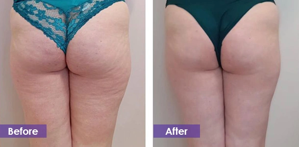 cryolipolysis Buttocks Tightening before and after