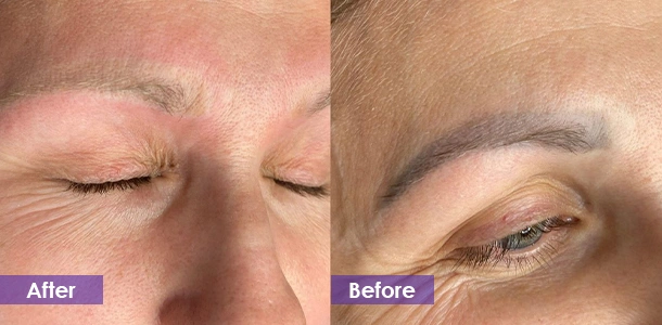 Eyebrow Tattoo Removal treatment