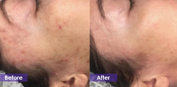 fractional RF microneedling Acne Treatment before and after