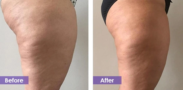 Leg shaping before and after