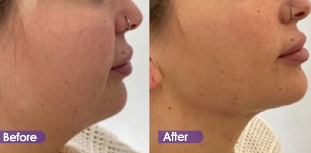 Jawline tightening Treatment effect