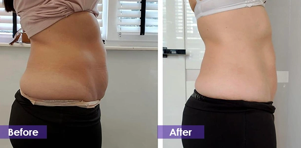 EMS Body Sculpting Abdominal Firming before and after