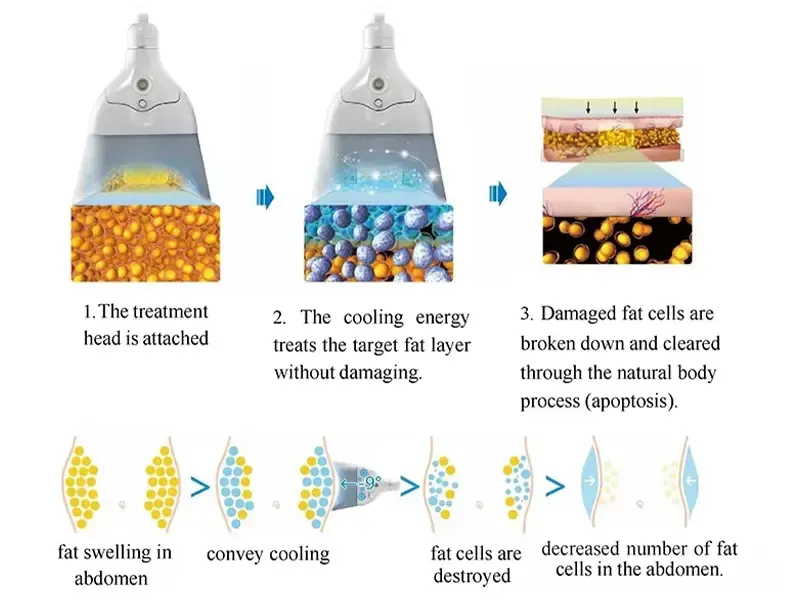 How does Cryolipolysis work?