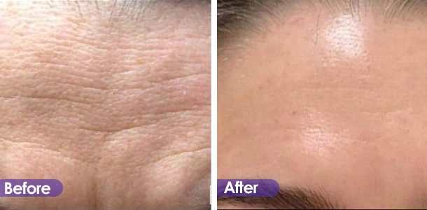 Forehead wrinkle removal before and after