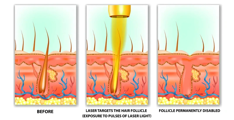 Diode laser Working Principle