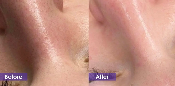 Improve skin before and after