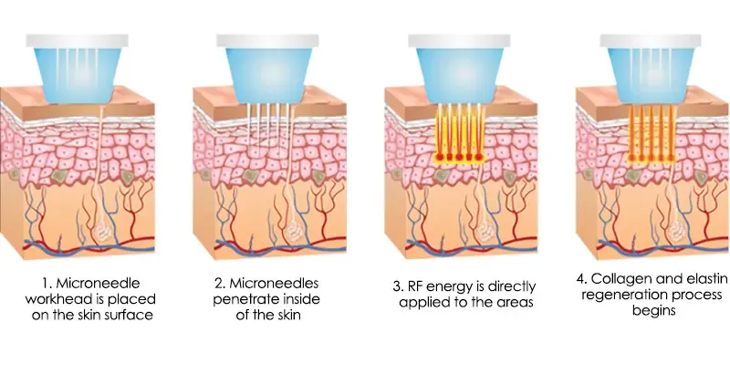 How does Microneedle Fractional RF device work?