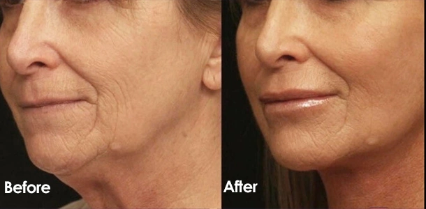 Facial firming before and after