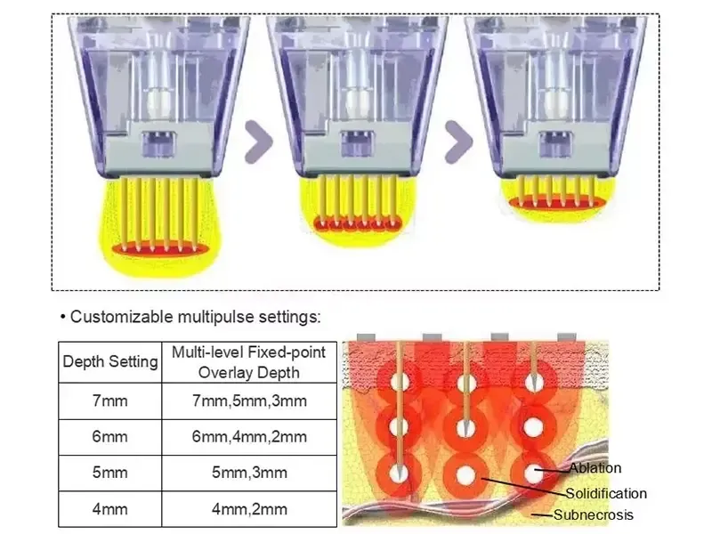 How does fractional RF microneedling work?