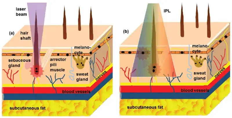 Working Principle of a Diode Laser Machine