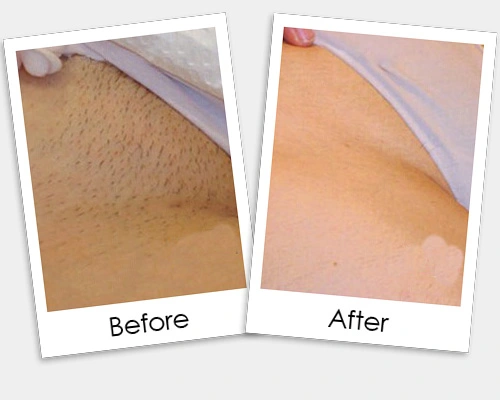 Bikini Hair Removal Treatment