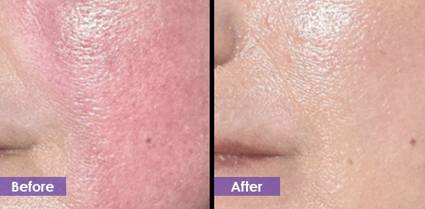 Facial redness removal