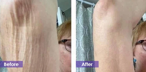 EMS Body Sculpting Arm Firming before and after