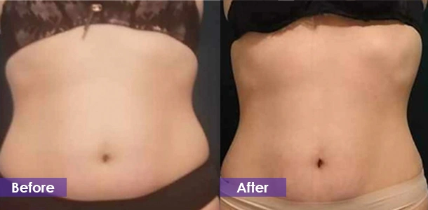 Abdominal firming before and after