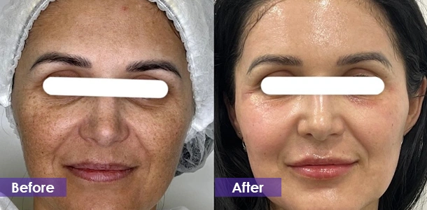 Pico laser pigmentation removal before and after