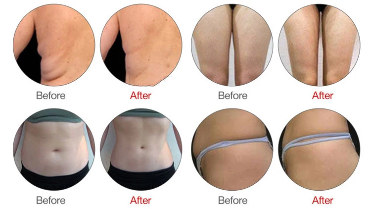 Mini EMS Body Sculpt Machine Before & After