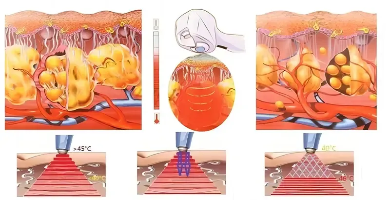 How does RF body contouring work?