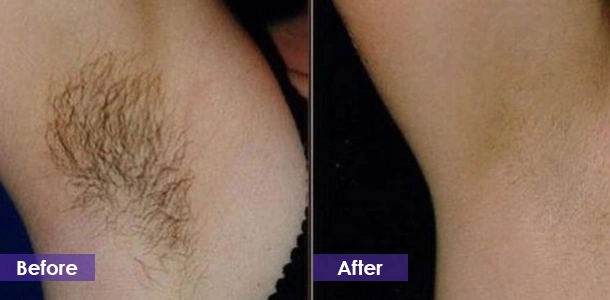 man Underarm hair removal