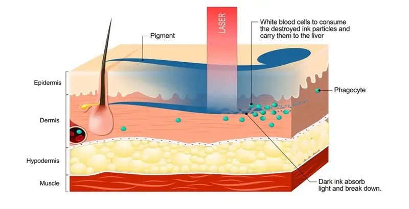 How does laser tattoo removal work?