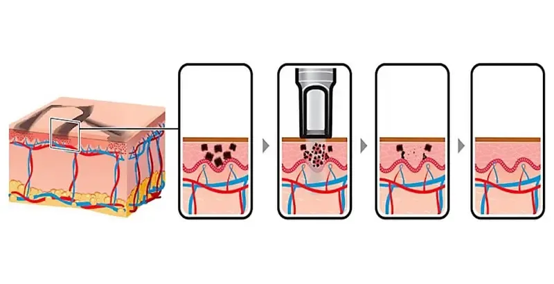 How does laser tattoo removal machine work?