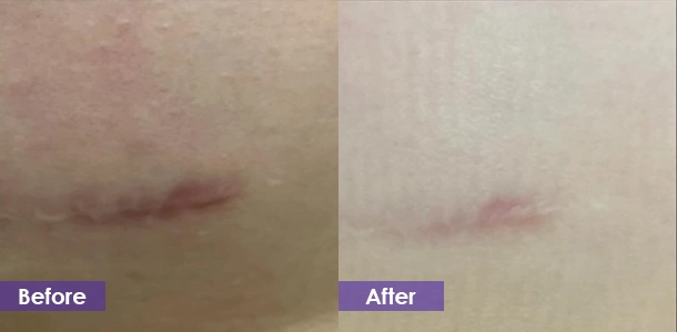 Microneedle RF to reduce scars before and after