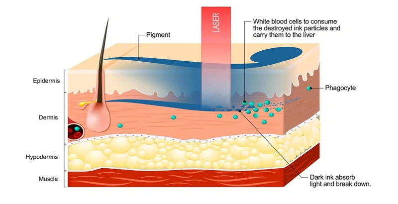 How Q-switched Nd:YAG laser work?