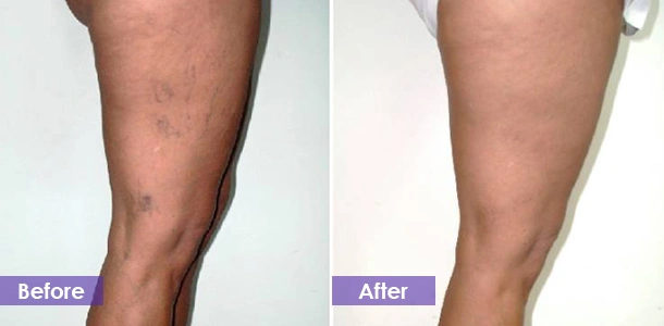 Varicose vein removal on the legs before and after