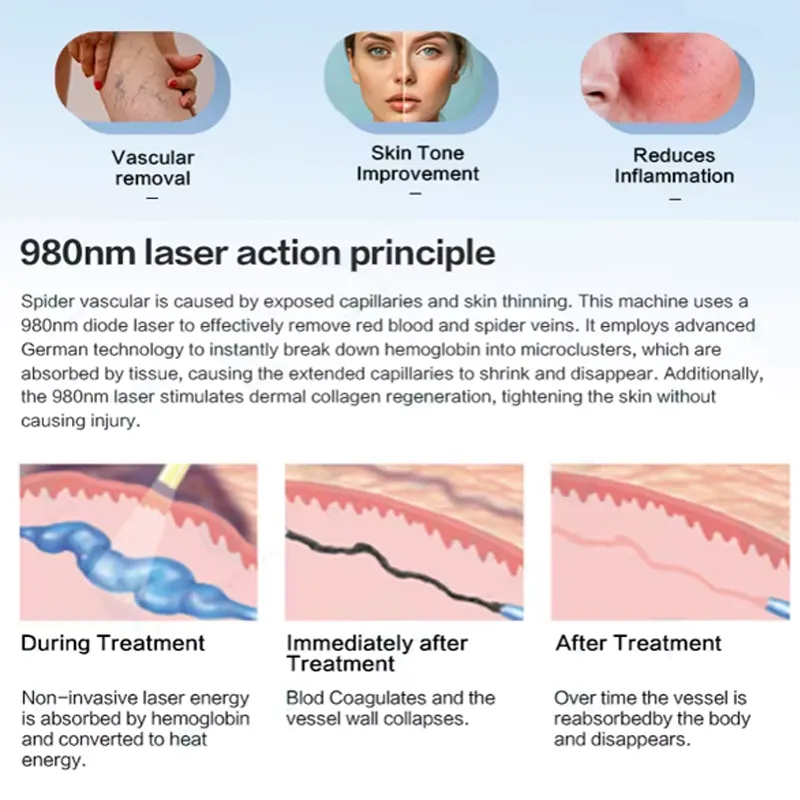 980nm Diode Laser Working Principle