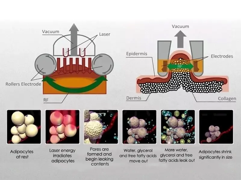 How does vacuum roller Body shaping work?