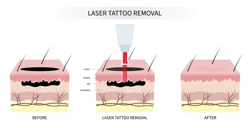 How does ND YAG LASER Works?
