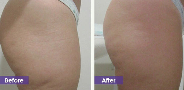 cryo for treatment Buttocks
