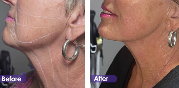 Jawline tightening before and after