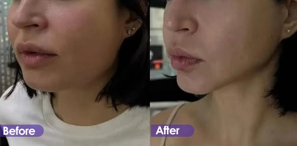 Portable RET Face tightening before and after