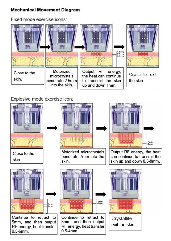 How Microneedle Radiofrequency (RF) work ?