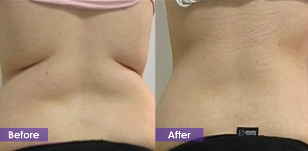 Waist fat dissolving and plastic surgery before and after