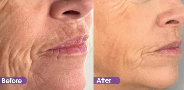 Lip wrinkle removal and firming Treatment effect