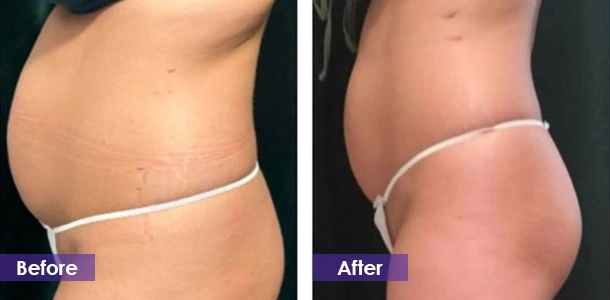 cryolipolysis Abdominal Tightening before and after