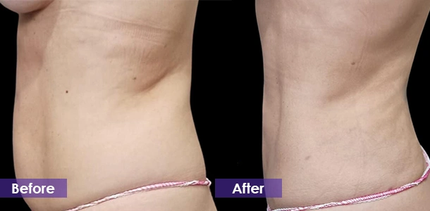 cryo for treatment waist
