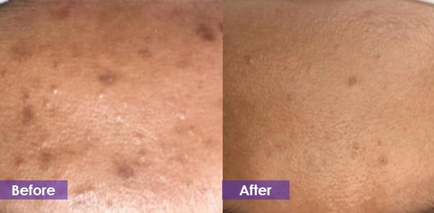 fractional RF microneedling Acne Scar Removal before and after