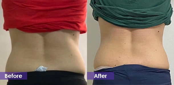 EMS Body Sculpting Waist Tightening before and after