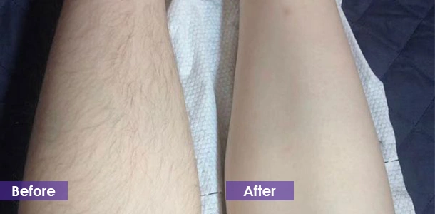 Leg hair removal
