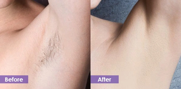 Diode Laser Underarm Hair Removal treatment