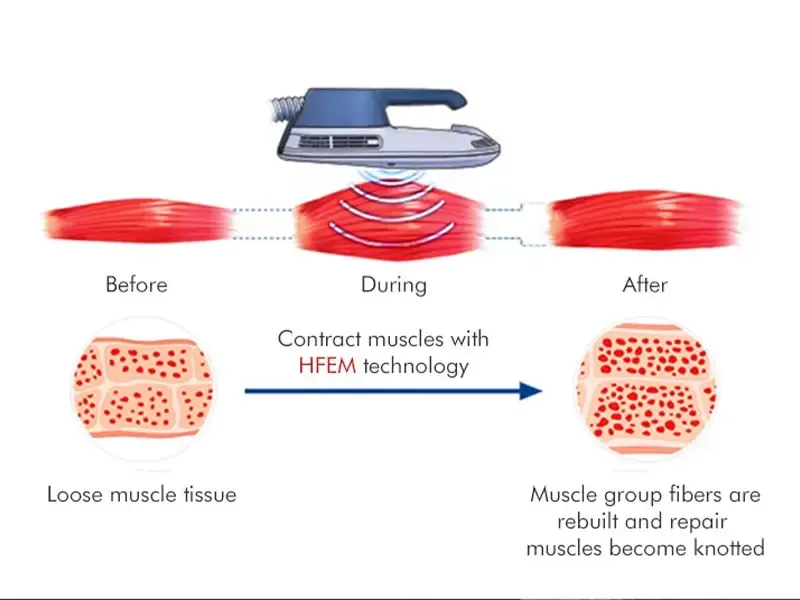 How does the EMS NEO RF slimming machine work?