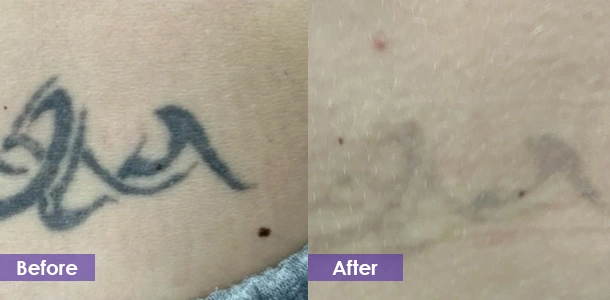 Tattoo removal before and after