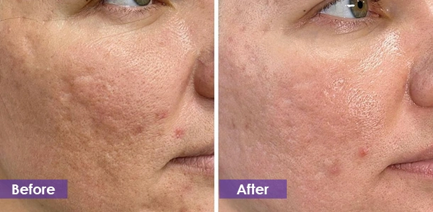 Shrink pores before and after