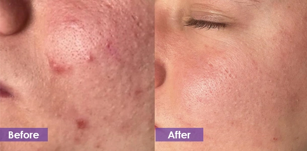 IPL Acne Treatment