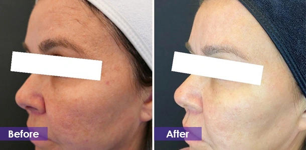 Skin Rejuvenation before and after