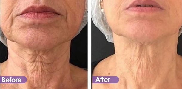 Neck wrinkle removal and firming Treatment effect